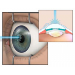Эксимер-лазерная коррекция зрения Октопус "Lasik"