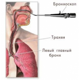 Фибробронхоскопия