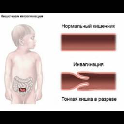 Инвагинация кишечника