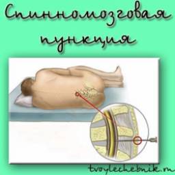 Люмбальная (спинномозговая) пункция (поясничный прокол)