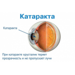 Операция по удалению катаракты с заменой хрусталика