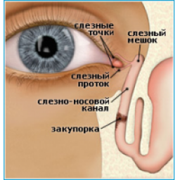 Зондирование (бужирование) слезного канала